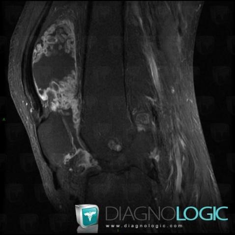 Lipoma arborescens, Femorotibial joints - Intercondylar notch, MRI