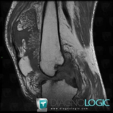 Lipoma arborescens, Femorotibial joints - Intercondylar notch, Other soft tissues/nerves - Knee, MRI