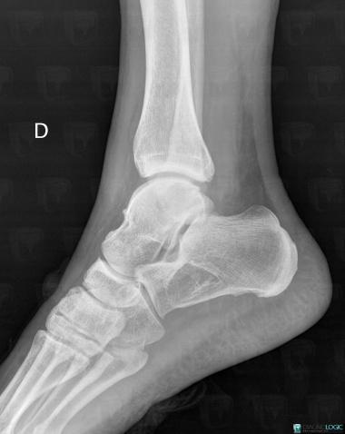 Lipoma, Calcaneus, X rays