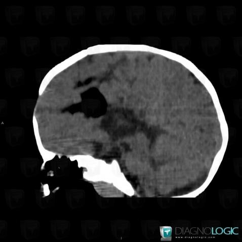 Lipoma, Cerebral falx / Midline, CT