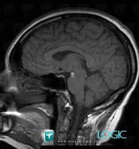 Lipoma, Cerebral falx / Midline, Infratentorial peri cerebral spaces, MRI