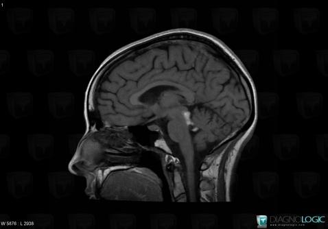 Lipoma, Cerebral falx / Midline, Infratentorial peri cerebral spaces, MRI