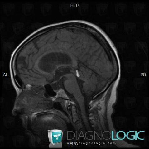 Lipoma, Cerebral falx / Midline, Infratentorial peri cerebral spaces, MRI