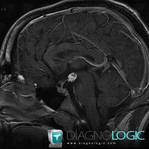 Lipoma, Cerebral falx / Midline, MRI