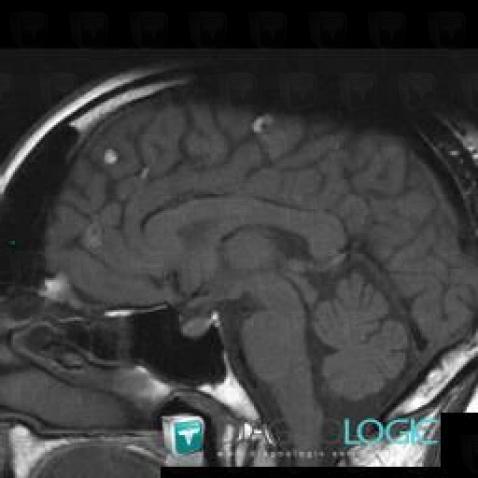 Lipoma, Cerebral hemispheres, Cerebral falx / Midline, MRI