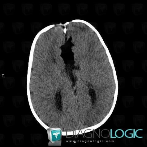 Lipoma, Cerebral hemispheres, CT