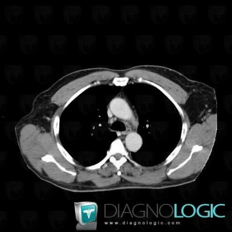 Lipoma, Chest wall, CT