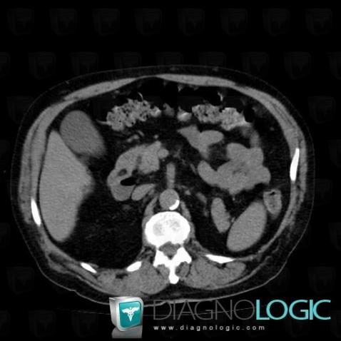 Lipoma, Duodenum, CT