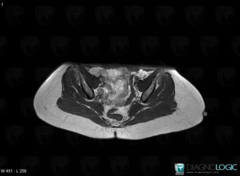 Lipoma, Other soft tissues/nerves - Pelvis, MRI