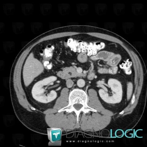 Lipoma, Pancreas, CT