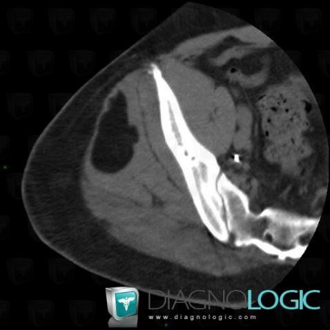 Lipoma, Pelvic Muscles, CT