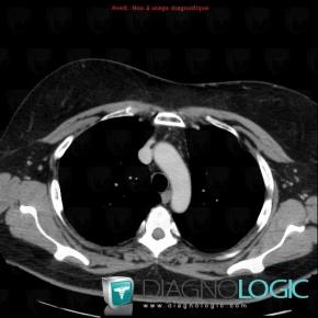 Lipoma, Pleura, CT