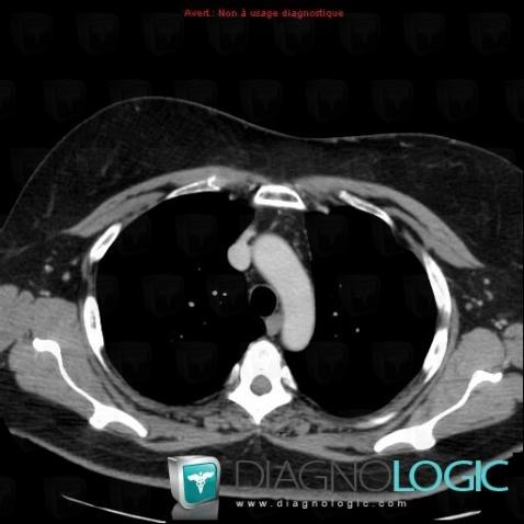 Lipoma, Pleura, CT