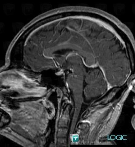 Lipoma, Posterior fossa, MRI