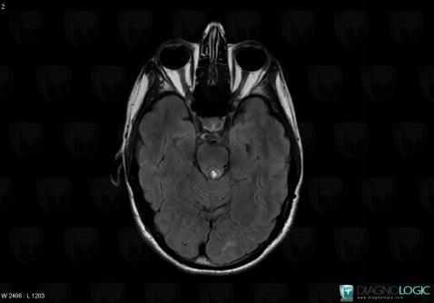 Lipoma, Posterior fossa, MRI