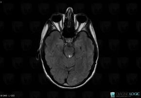 Lipoma, Posterior fossa, MRI