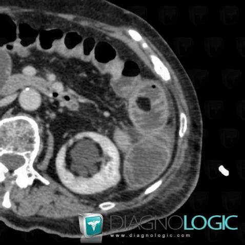 Lipoma, Small bowel, CT