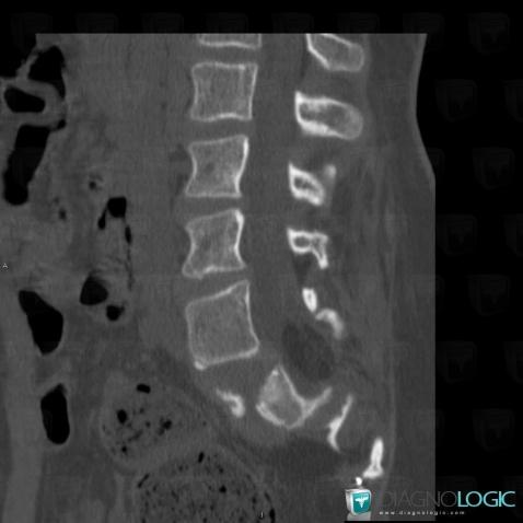 Lipoma, Spinal canal / Cord, CT