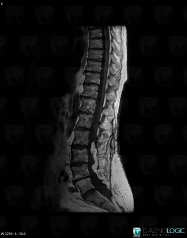 Lipoma, Spinal canal / Cord, MRI