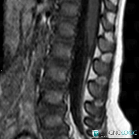 Lipoma, Spinal canal / Cord, MRI