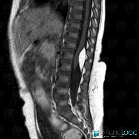 Radiology case : Lipoma (MRI) - Diagnologic