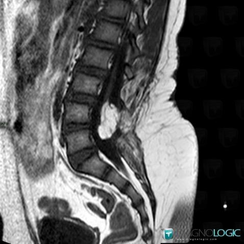 Lipoma, Spinal canal / Cord, MRI