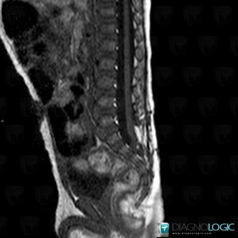 Lipoma, Spinal canal / Cord, MRI