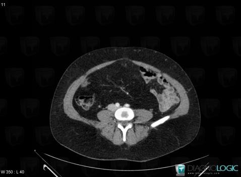 Lipomatosis, Mesentery / Peritoneum, CT