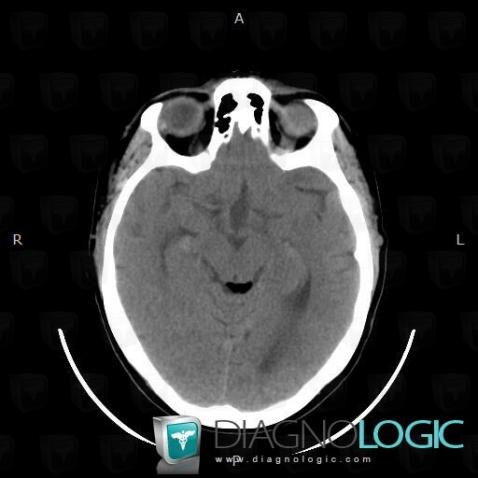 Lipome, Faux-cerveau / Ligne médiane, Espaces peri cérébraux infratentoriels, Scanner