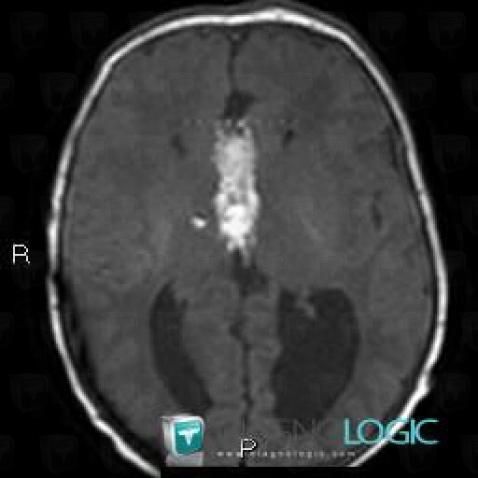 Lipome, Hémisphères cérébraux, Faux-cerveau / Ligne médiane, IRM