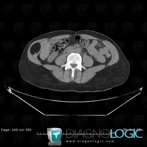 Lipome, Paroi abdominale, TDM