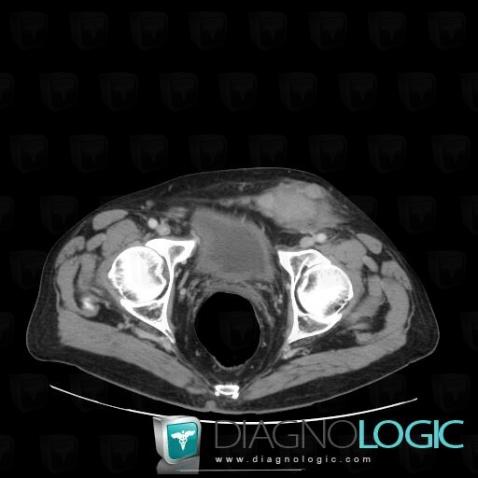 Liposarcoma, Abdominal wall, CT