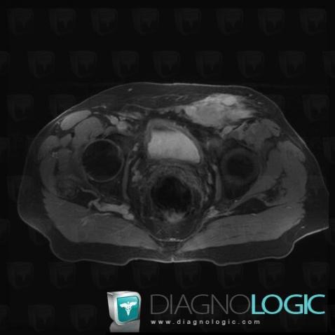 Liposarcoma, Abdominal wall, MRI