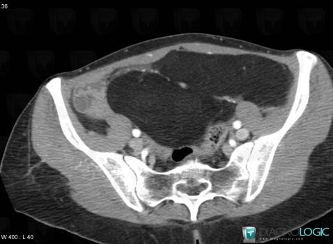 Liposarcoma, Mesentery / Peritoneum, CT