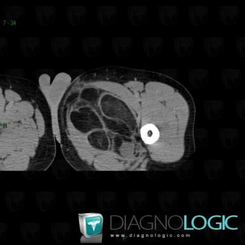 Liposarcoma, Muscles - Thigh, Other soft tissues/nerves - Thigh, CT