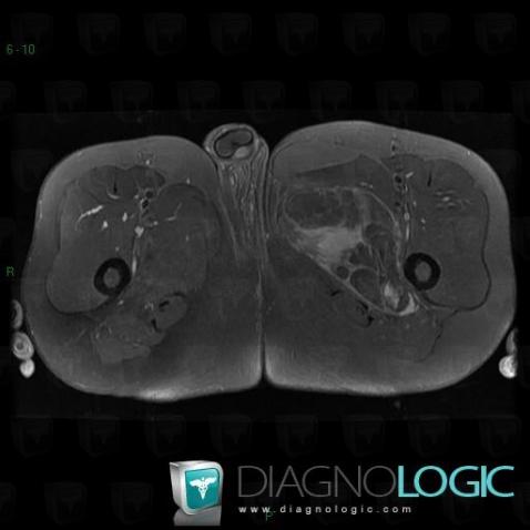 Liposarcoma, Muscles - Thigh, Other soft tissues/nerves - Thigh, MRI