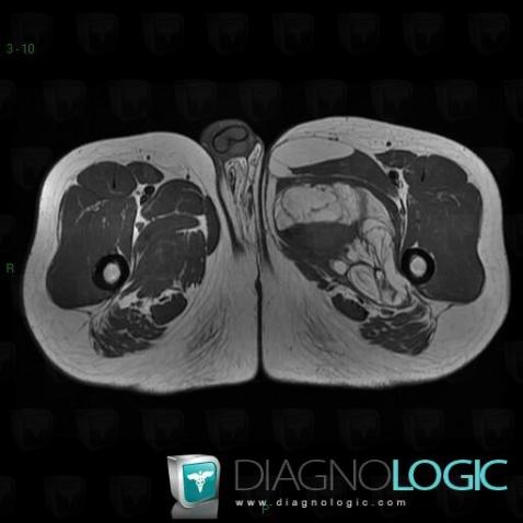 Liposarcoma, Muscles - Thigh, Other soft tissues/nerves - Thigh, MRI