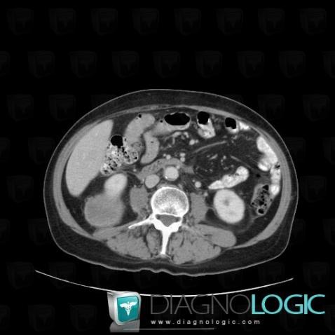 Liposarcoma, Retroperitoneum, CT