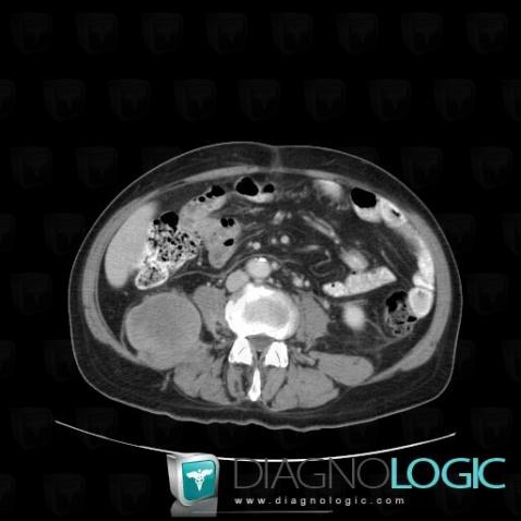 Liposarcoma, Retroperitoneum, CT