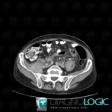 Liposarcoma, Retroperitoneum, CT