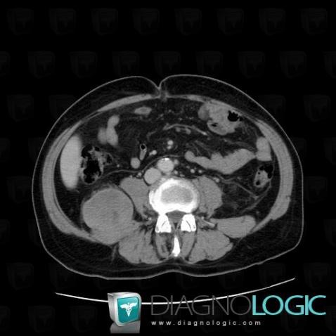 Liposarcoma, Retroperitoneum, CT