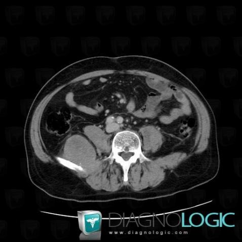 Liposarcoma, Retroperitoneum, CT