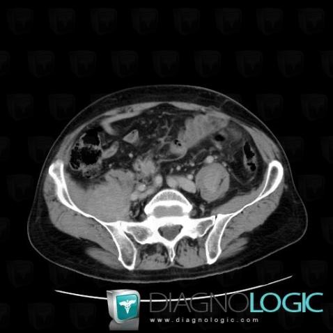 Liposarcoma, Retroperitoneum, CT