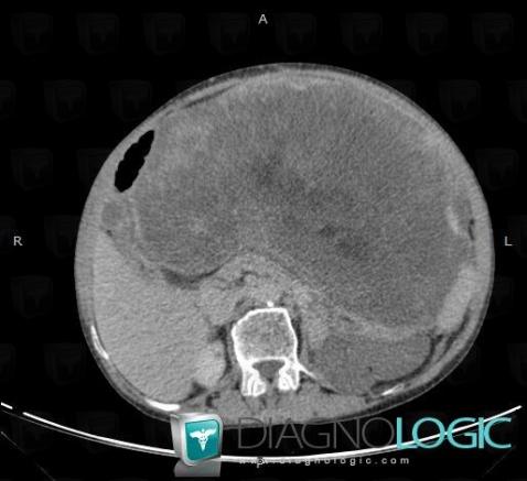 Liposarcoma, Retroperitoneum, CT