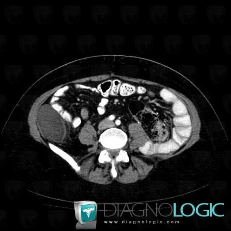 Liposarcoma, Retroperitoneum, CT