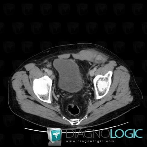 Liposarcome, Paroi abdominale, Scanner