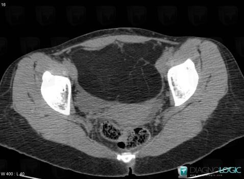 Liposarcome, Pelvis / Périnée, Scanner