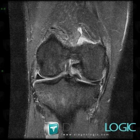 Longitudinal meniscal tear, Meniscus, MRI