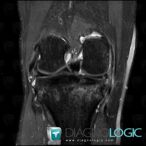 Longitudinal meniscal tear, Meniscus, MRI