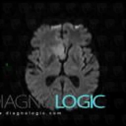 Low grade astrocytoma, Basal ganglia and capsule, Brainstem, Theoretical